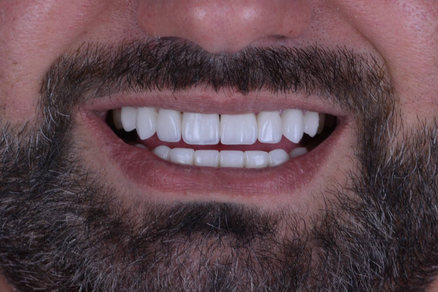 بعد تغير لون و شكل الأسنان لإعادة تأهيل الابتسامة